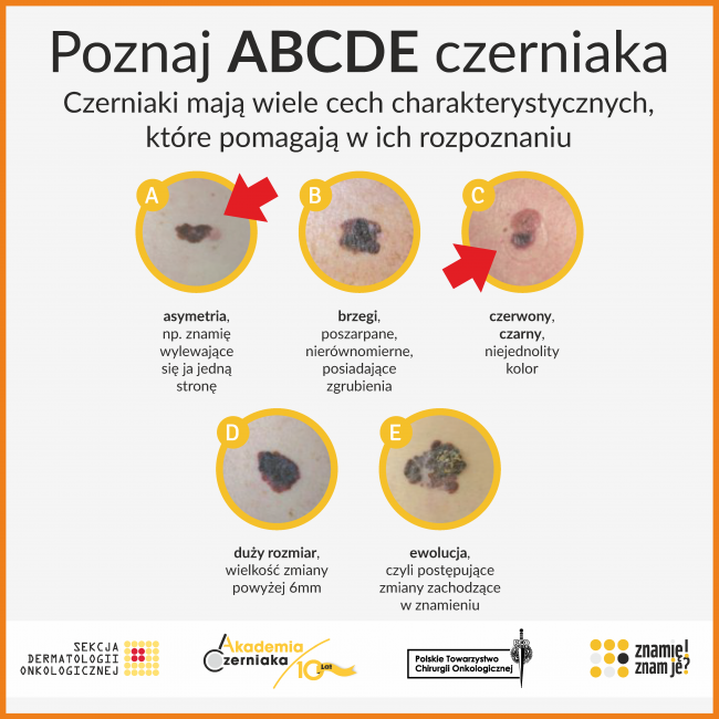 ABCDE czerniak